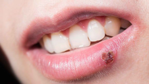 (Added Article) Cold Facts of Cold Sores