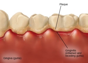 Facts Why You Must Not Ignore the Mild Gingivitis